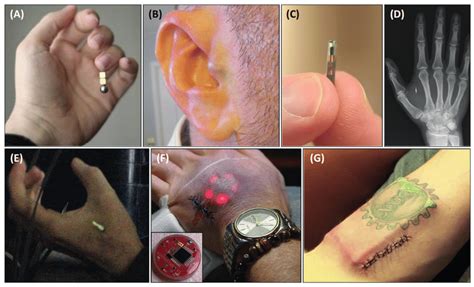 rfid implants for cancer